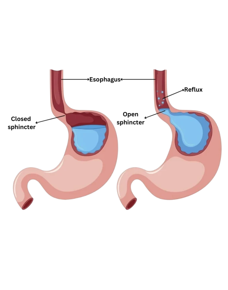 Gastroesophageal Reflux Disease GERD