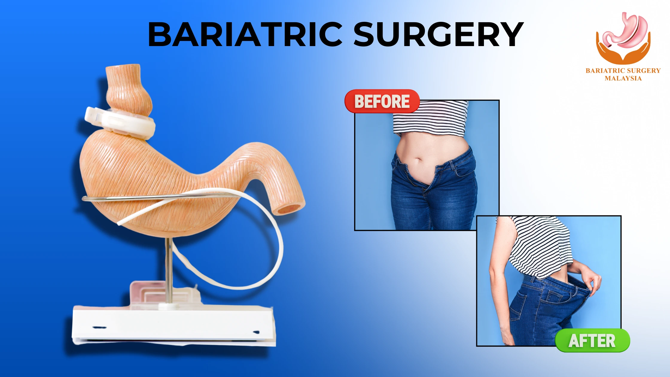 bariatric-surgery-before-after