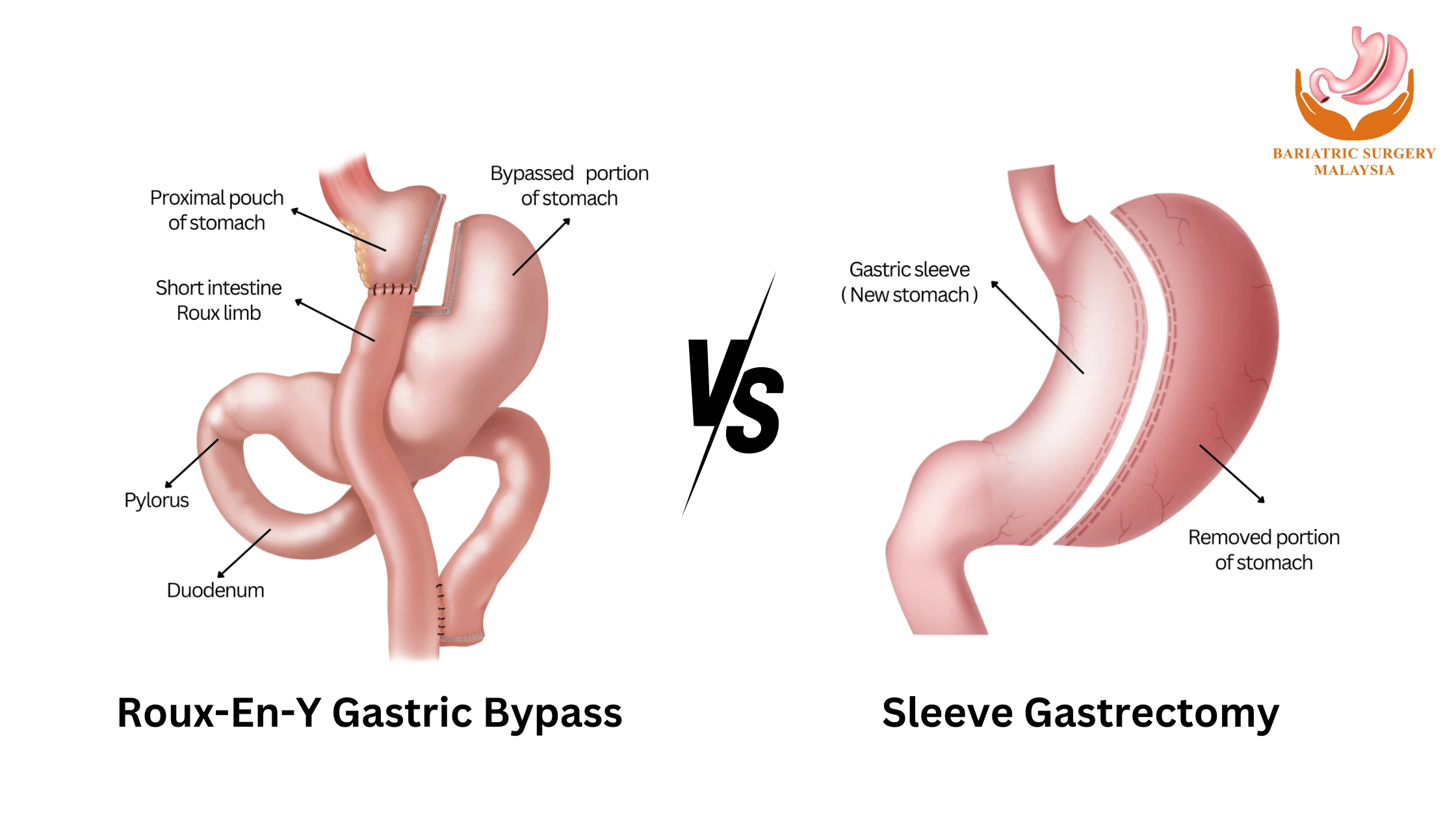 Gastric Bypass vs Sleeve