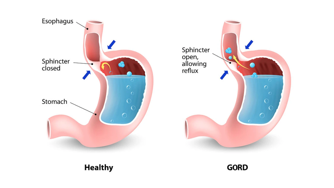 Gastroesophageal Reflux Surgery