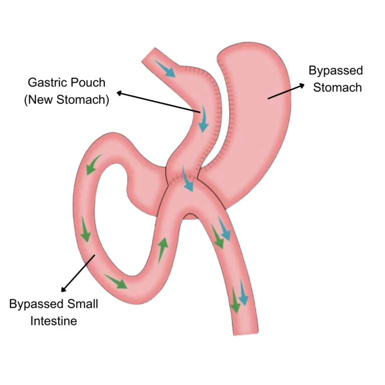 One Anastomosis Gastric Bypass OAGB