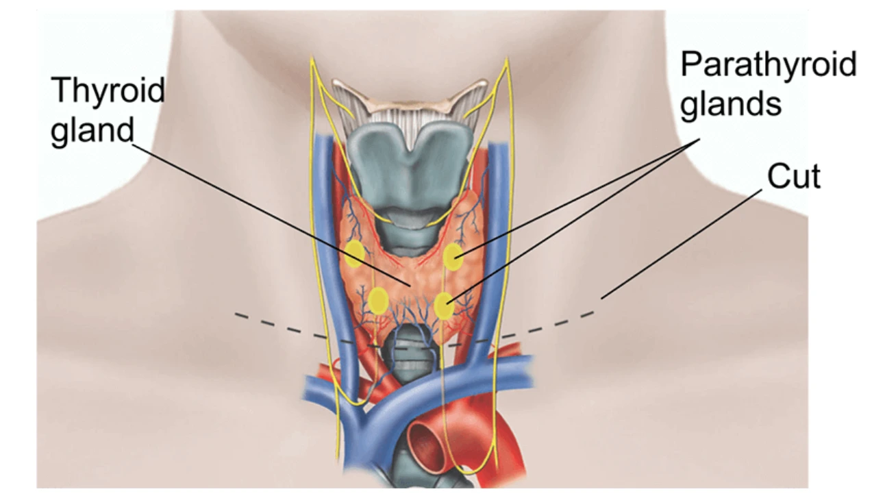 Parathyroid Surgery