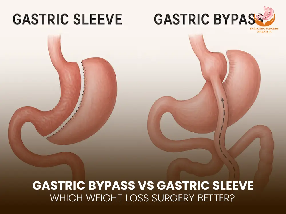 Gastric Bypass vs Gastric Sleeve