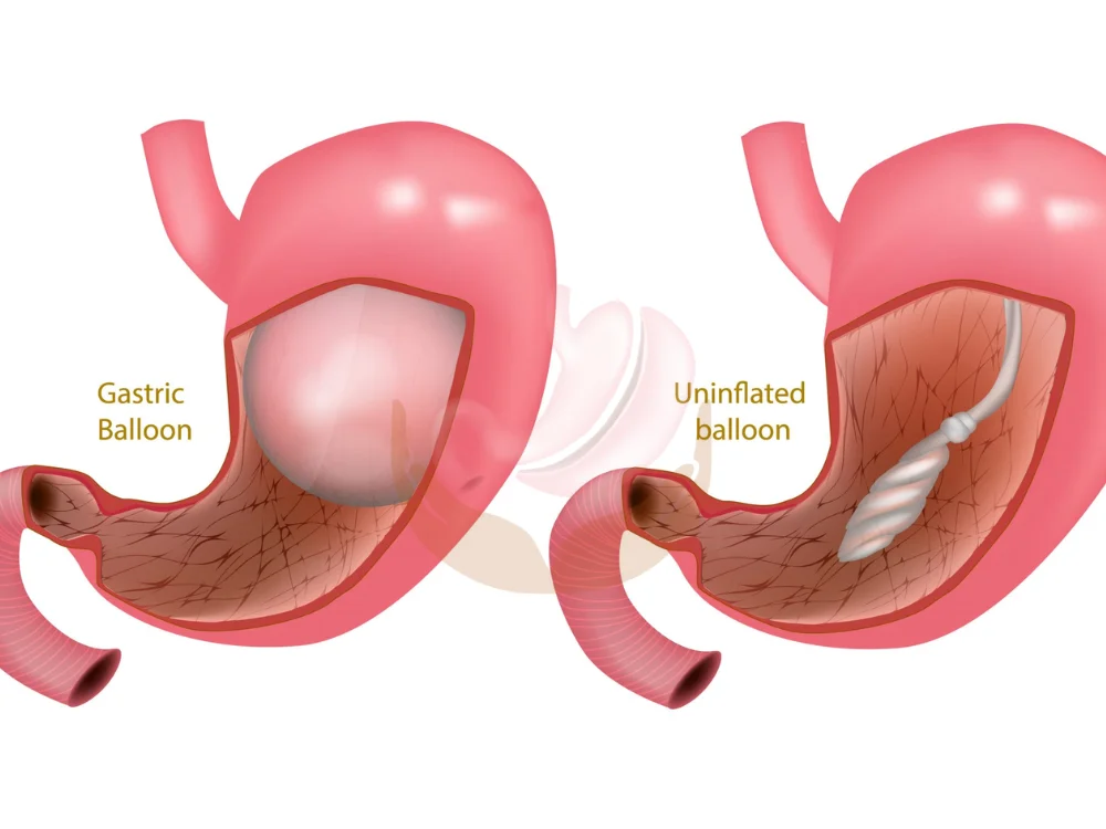 balloon-in-stomach-for-weight-loss-cost