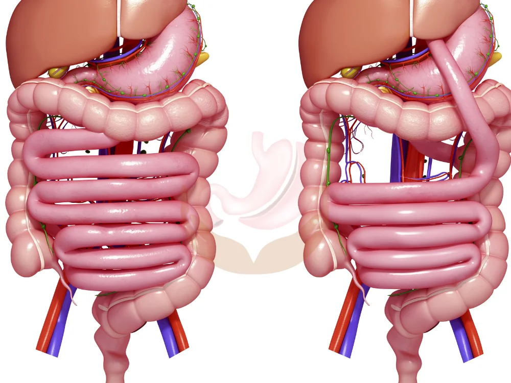 gastric-bypass