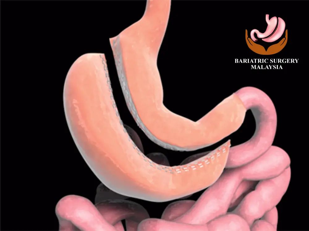 gastric-sleeve-gastrectomy