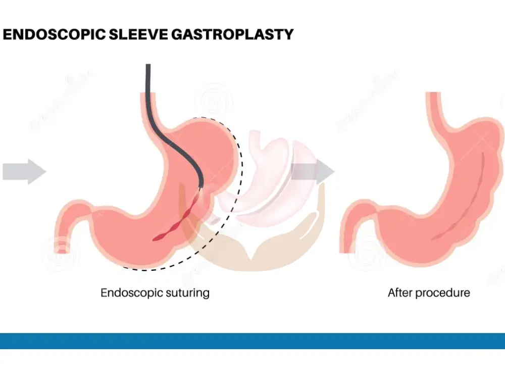 gastroplasty