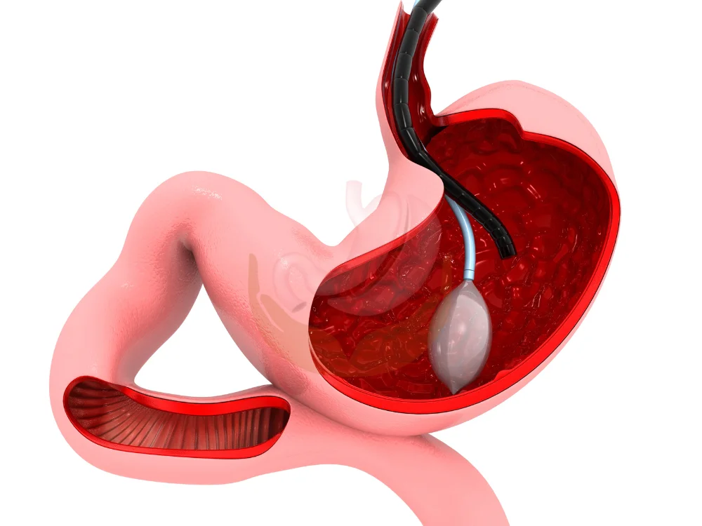 intra-gastric-balloon