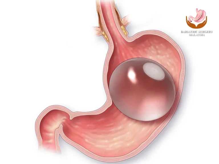 intragastric-balloon-cost