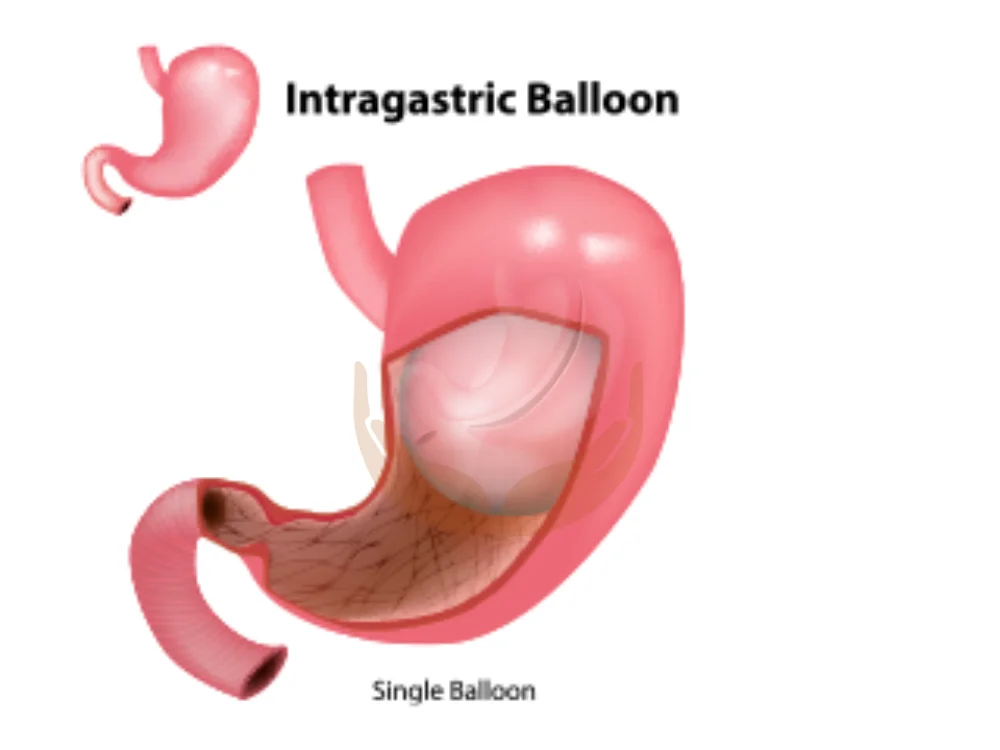 intragastric-balloon-cost