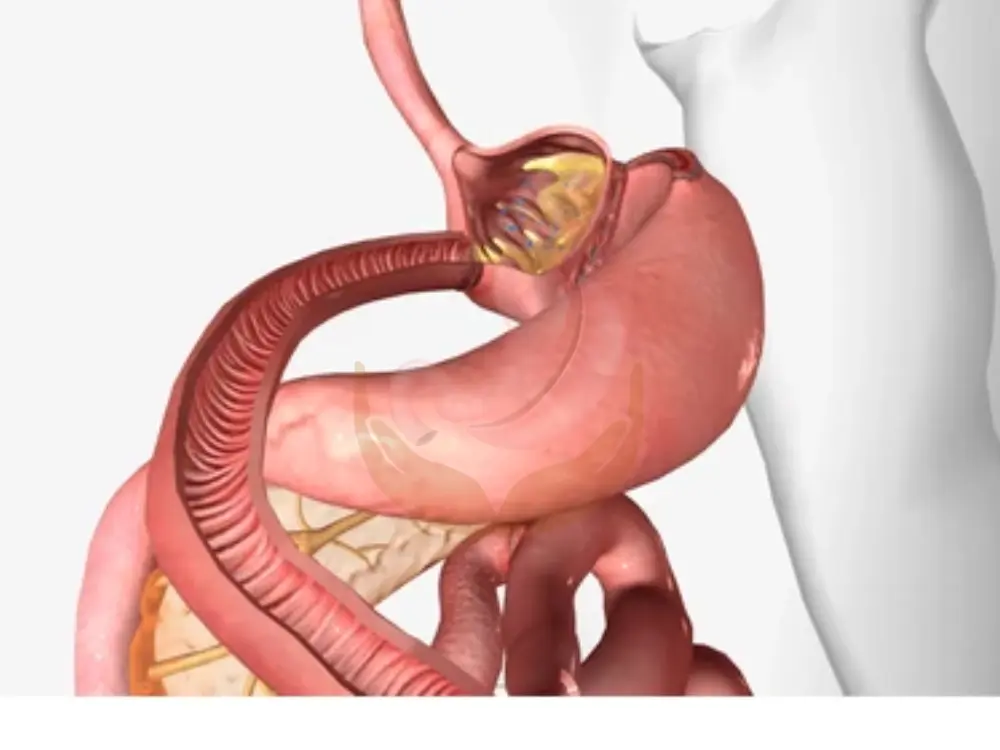 types-of-gastric-bypass-surgery