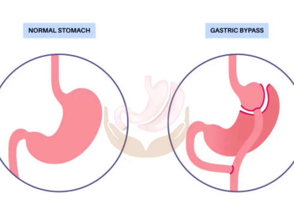 types-of-gastric-bypass-surgery