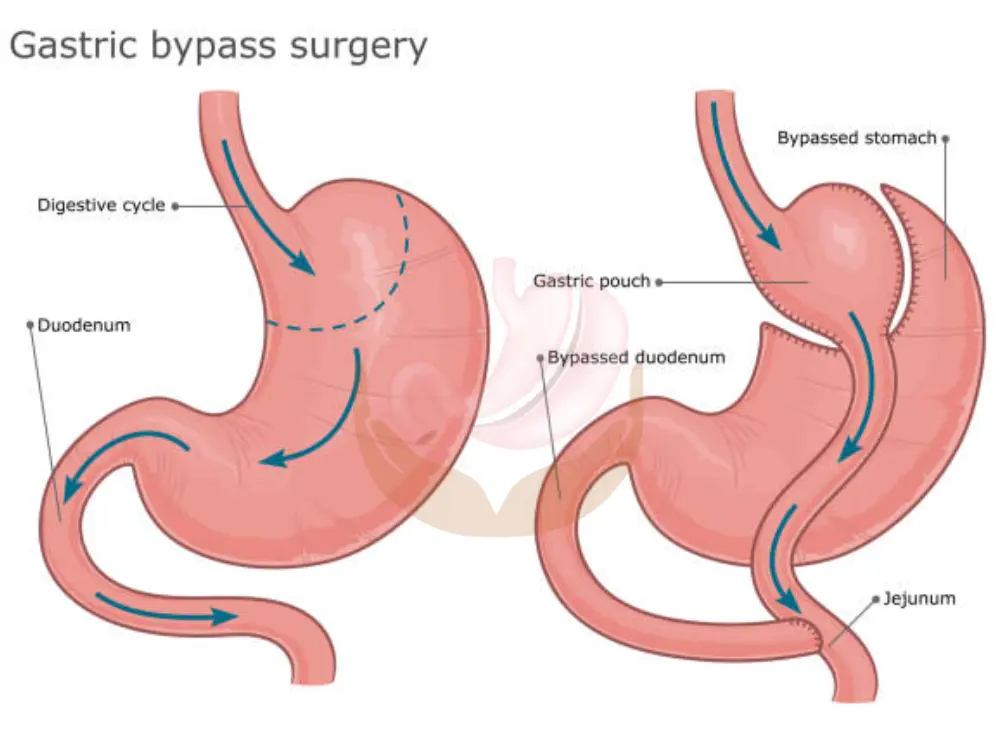 types-of-gastric-bypass-surgery