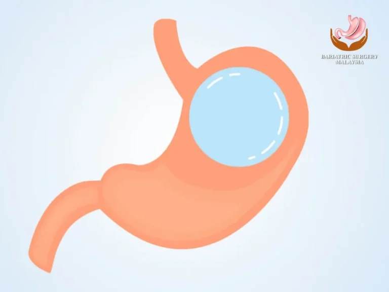 Gastric Balloon Near Me: 5 Powerful Reasons to Consider This Weight Loss Option