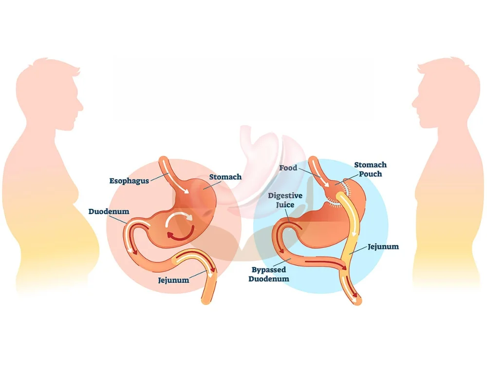 gastric-bypass-surgery