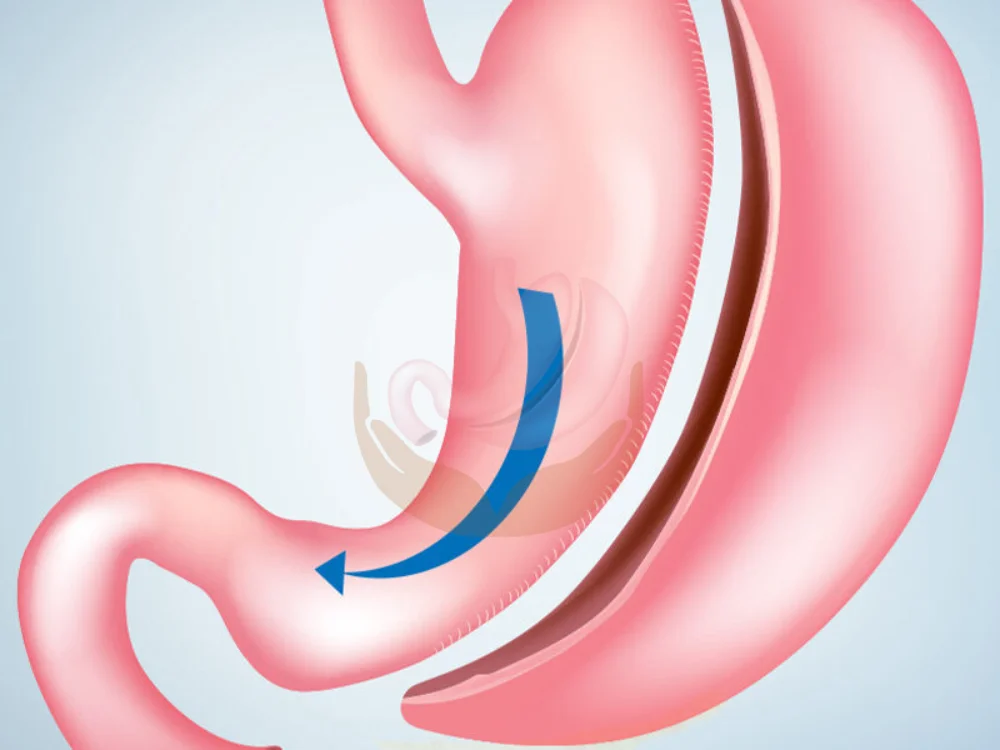 gastric-sleeve