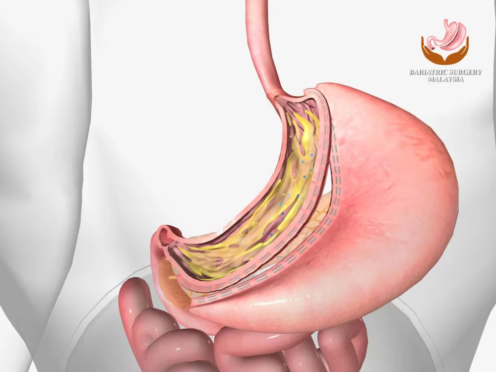 gastric-sleeve-procedure