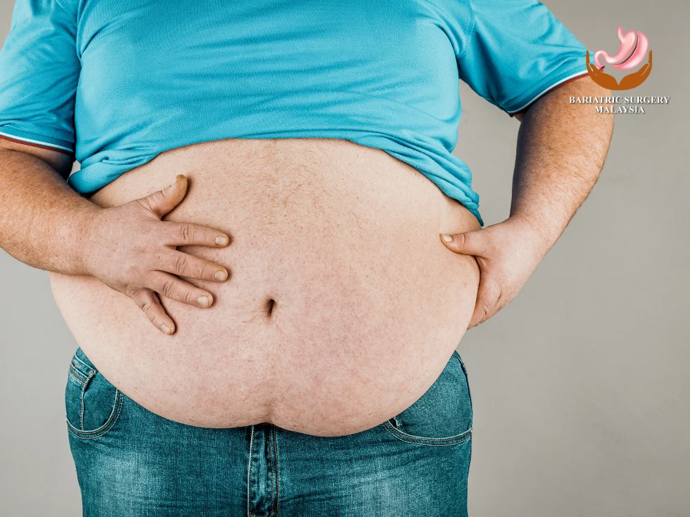 Cara Kurus Dengan Cepat & Selamat Untuk Turunkan Berat Badan (2025) 2 cara-kurus-dengan-cepat-obesity-operation