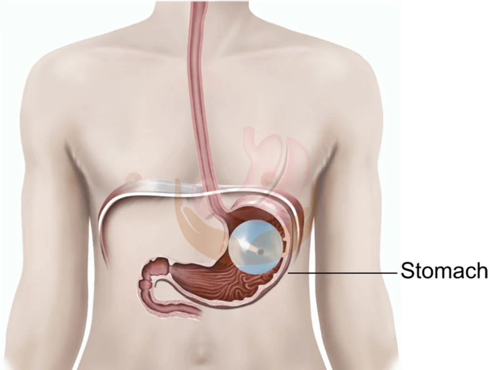 balloon-in-the-stomach