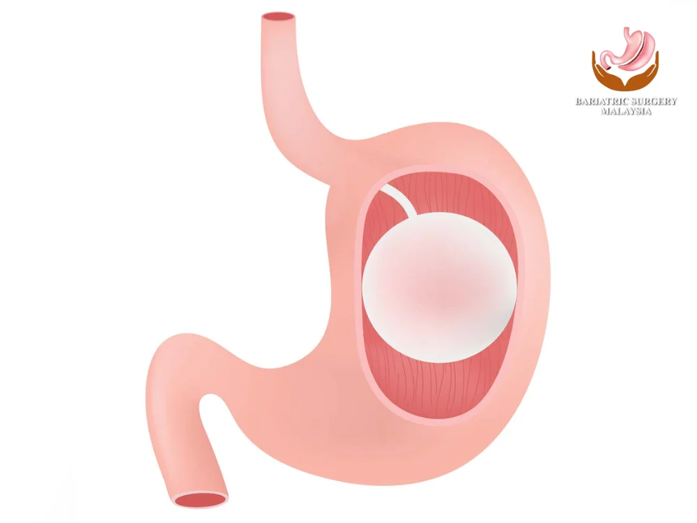 gastric-balloon-surgery