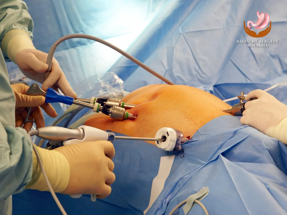 laparoscopic-sleeve