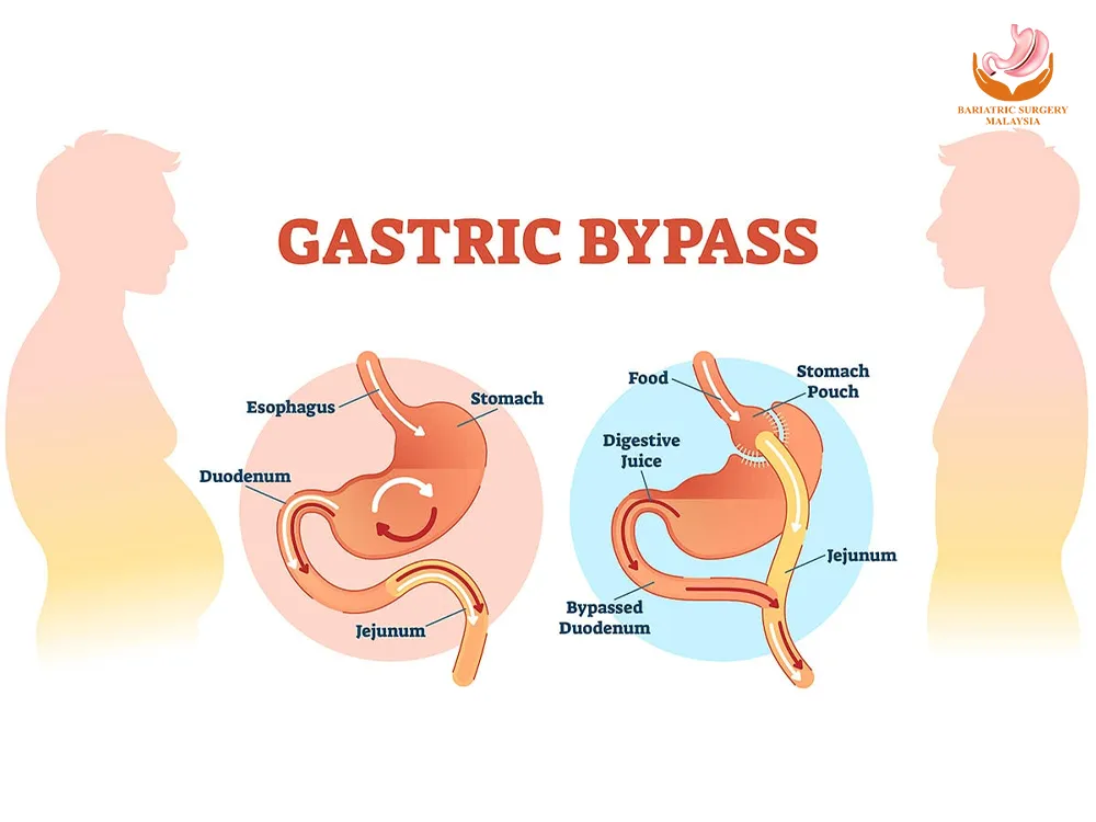 Gastric-Bypass-Surgery-malaysia-cost-procedure