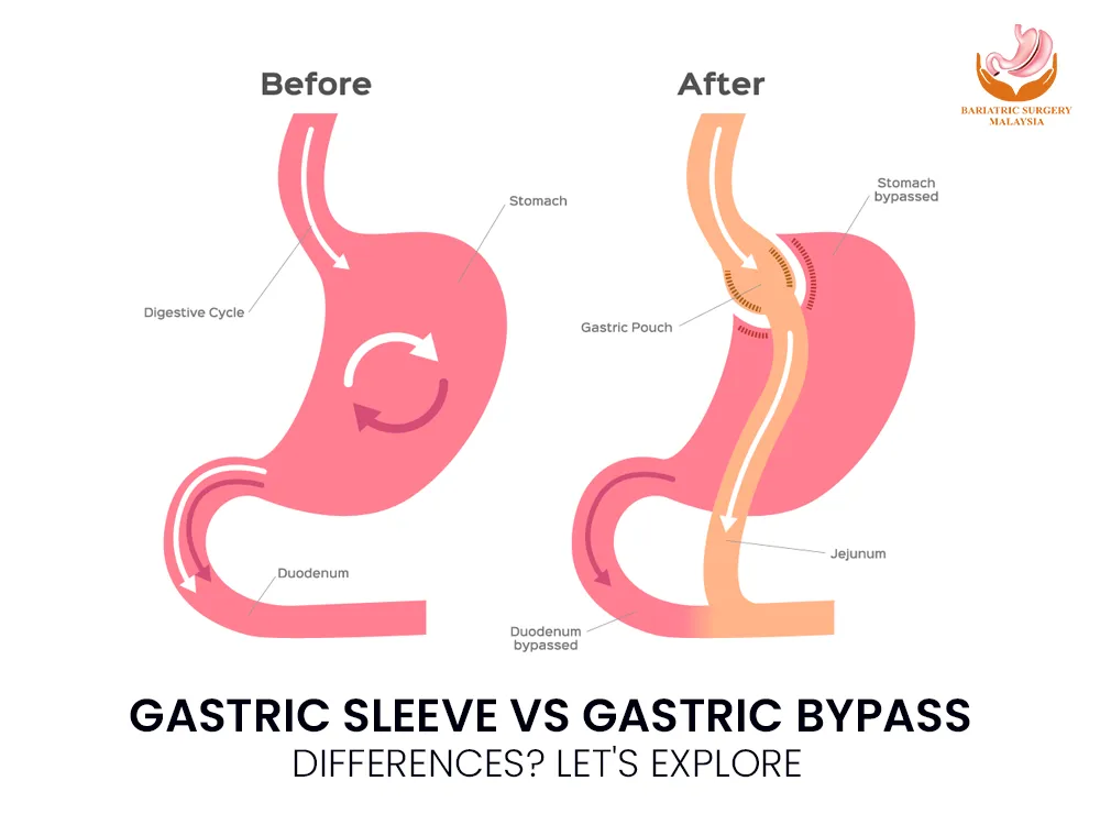 Gastric-Sleeve-Gastric-Bypass