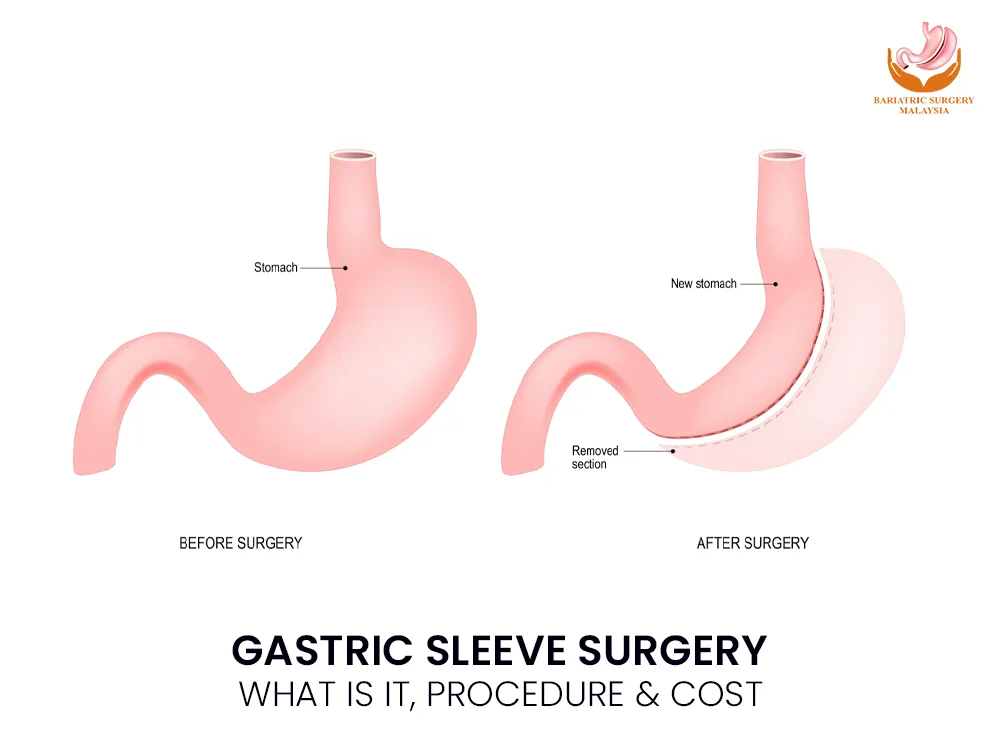 sleeve-surgery-gastric-1