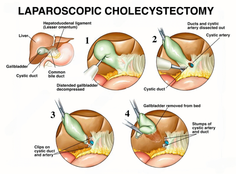 Gall-Bladder-Surgery-malaysia-kl