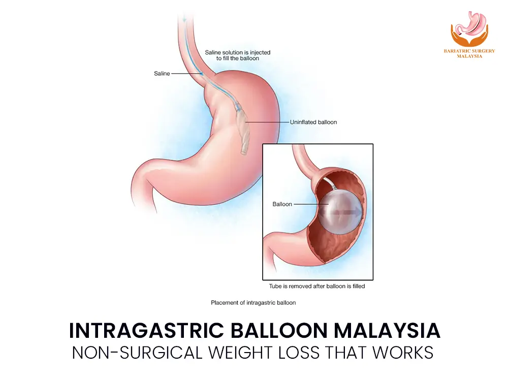 Intragastric-Balloon-Malaysia