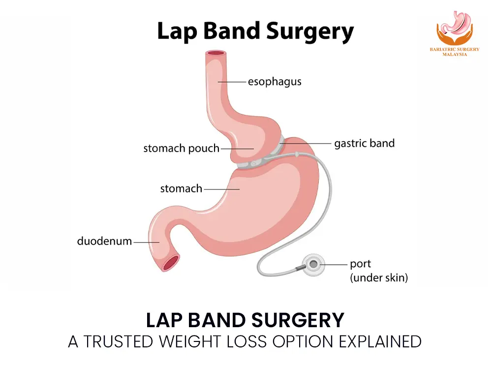 LAP-BAND-SURGERY