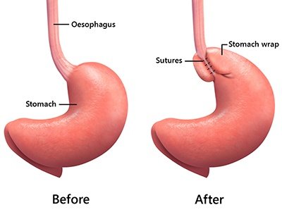 anti-reflux-surgery