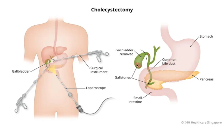 Gall-Bladder-Surgery-malaysia-kl