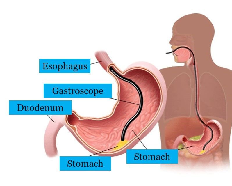 gastrokopi