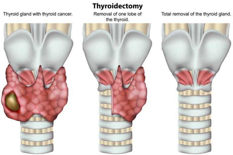 thyroidectomy-surgery