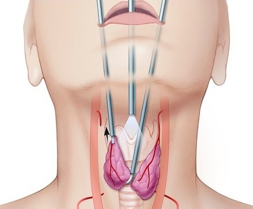thyroid-surgery-malaysia