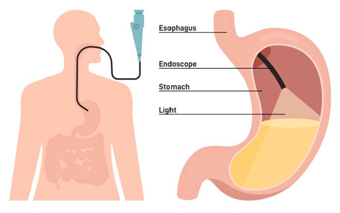 upper-endoscopy-malaysia