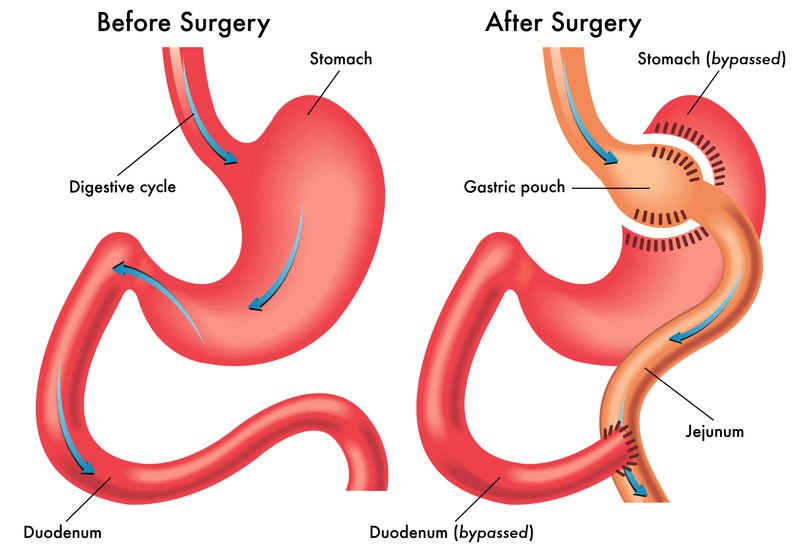 Gastric-Bypass-Surgery 