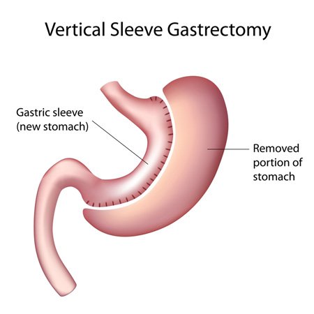 Gastric sleeve surgery