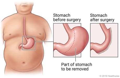 Gastric sleeve surgery