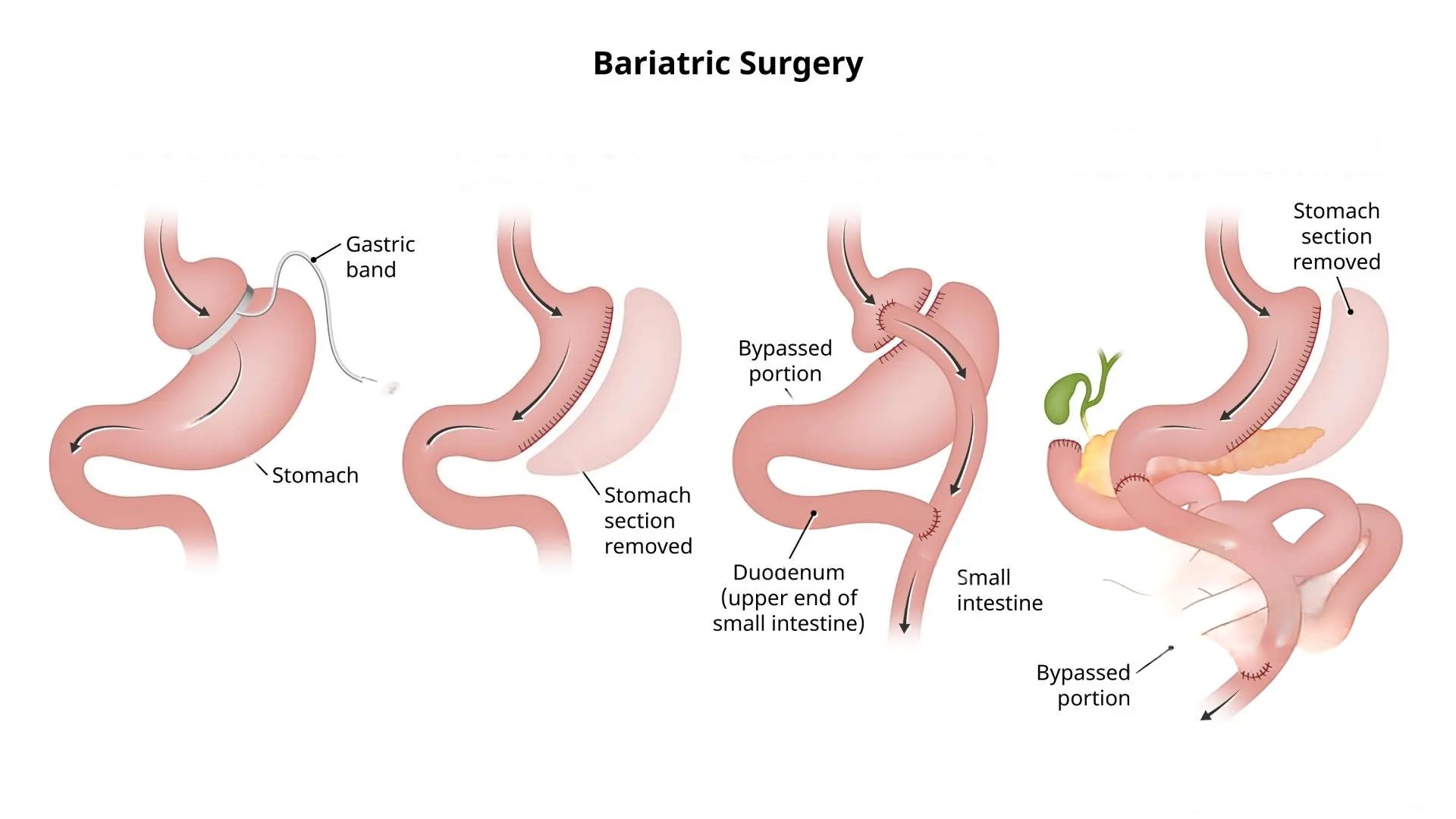 bariatrik