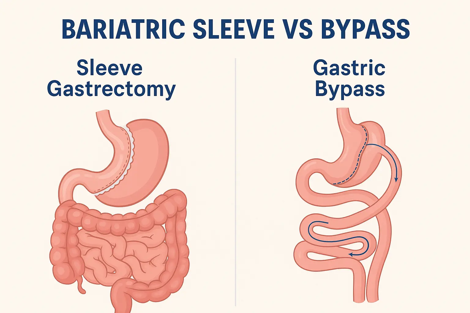 sleeve-gastrectomy-gastric-bypas
