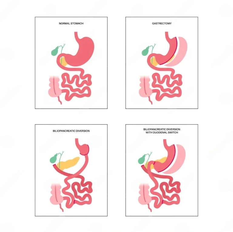 bariatric-surgery-types-procedure-malaysia