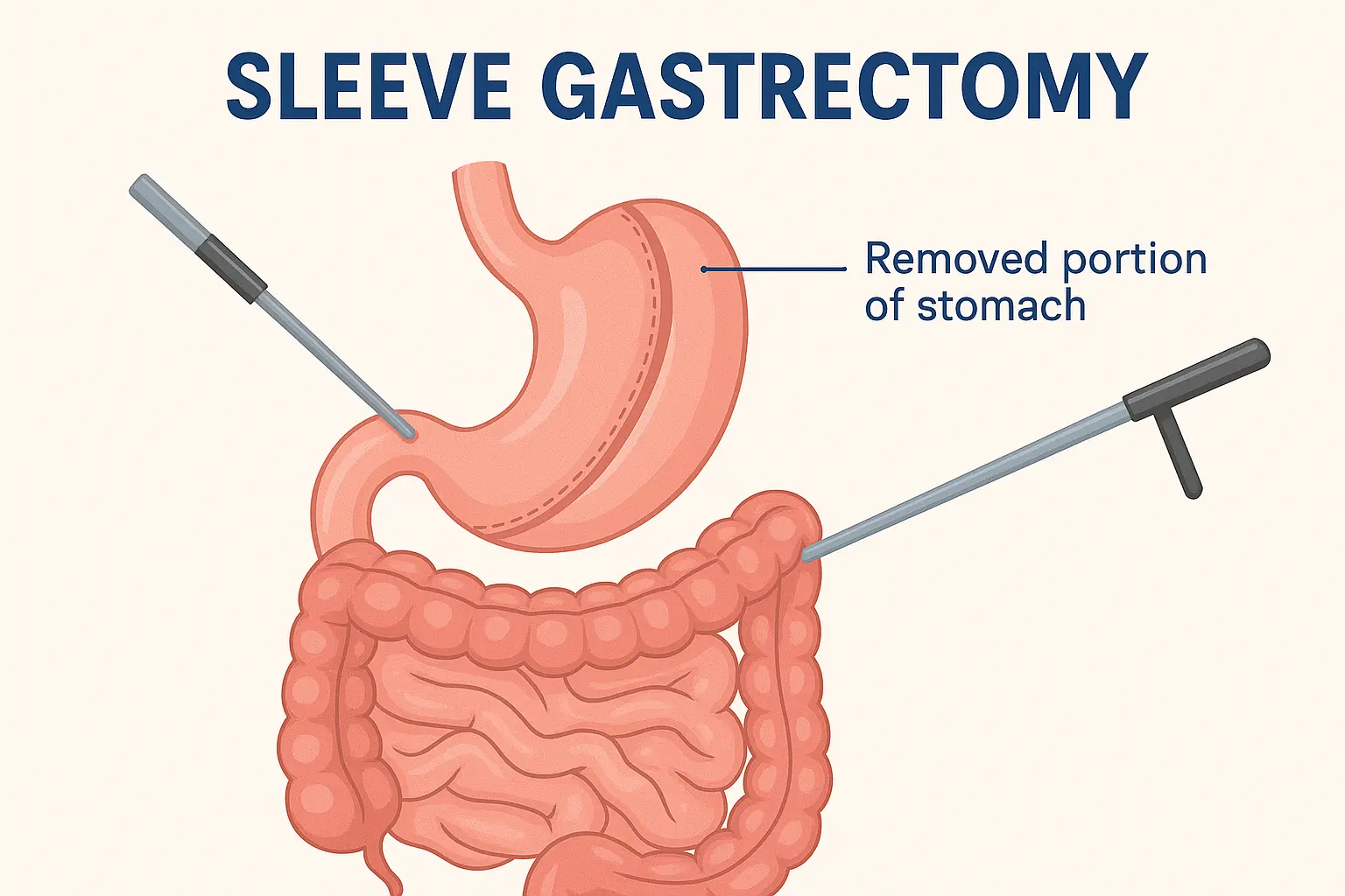 sleeve-gastrectomy