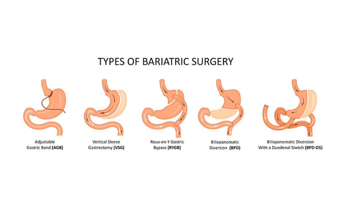 bariatrik