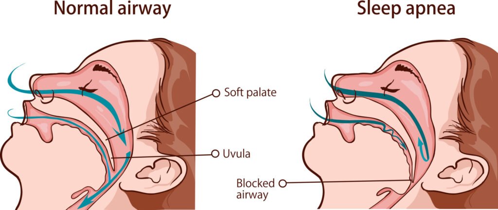 sleep-apnea-jenis
