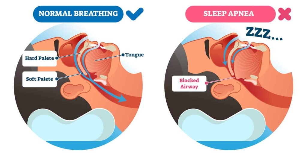 sleep-apnea-jenis