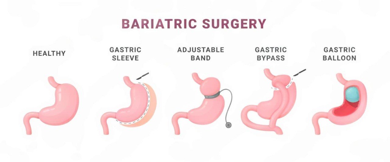 pembedahan-bariatrik-gastrik