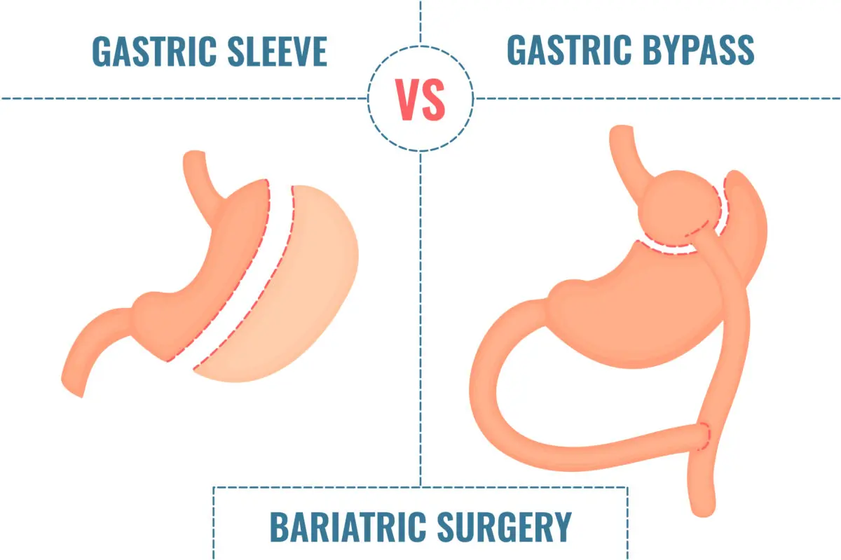 Gastric Bypass vs Gastric Sleeve: Which Weight Loss Surgery Better? 3 Gastric Bypass vs Gastric Sleeve