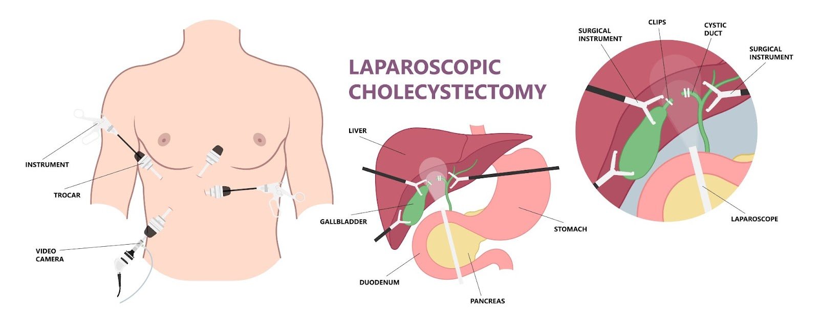 Batu Hempedu: Fungsi, Punca, Tanda, Rawatan & Kesan Buang Hempedu 3 Laparoscopic-cholecystectomy-rawatan-batu-hempedu